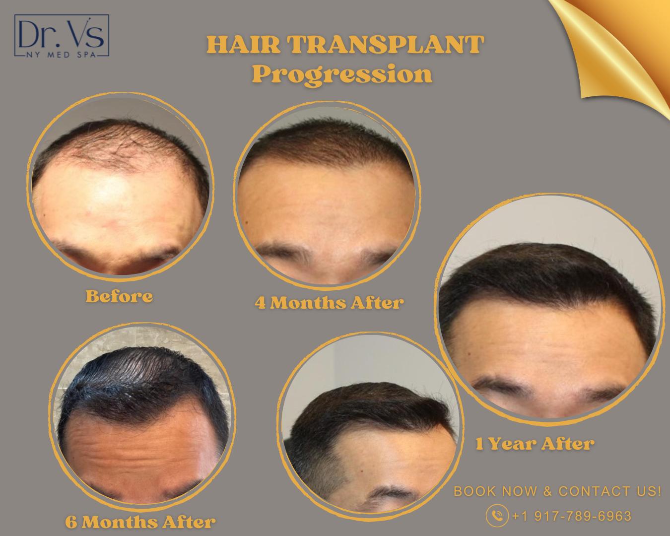 Hair transplant