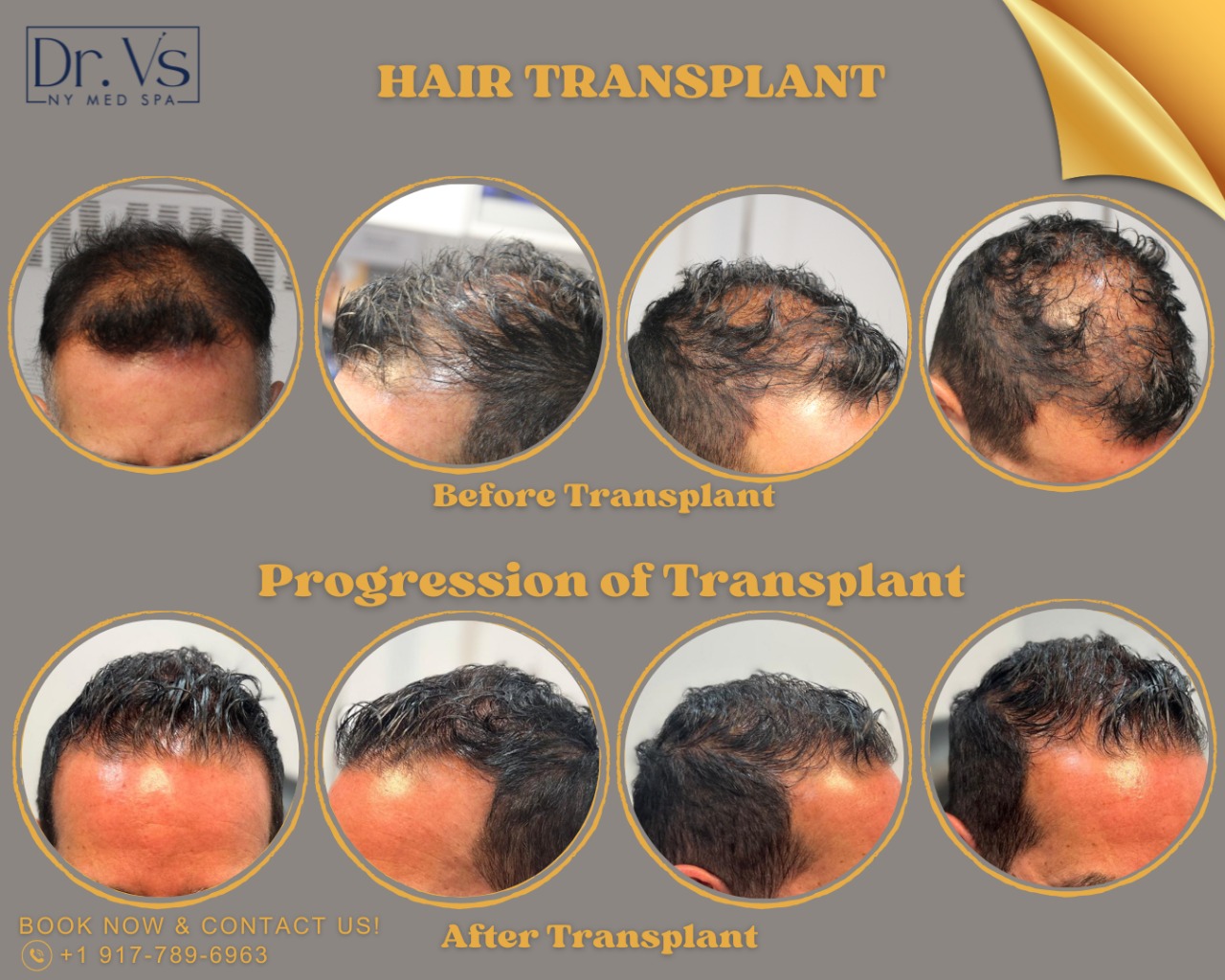 Hair transplant