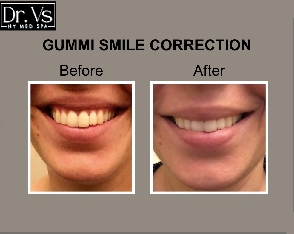 Gummi Smile Correction