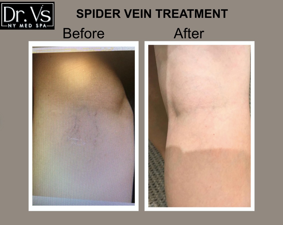 Vein Removal